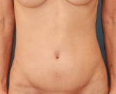 Feel Beautiful - TummyTuck LA - After Photo